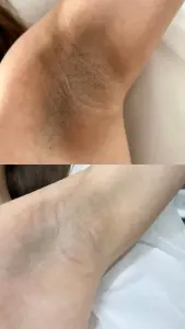 Интимное отбеливание